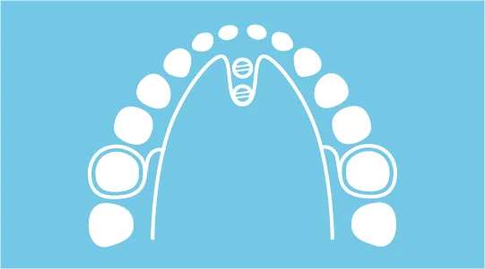 Schematische Darstellung: BeneSlider (Molaren-Distalisation)